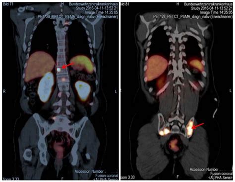 what is a psma pet scan for prostate cancer